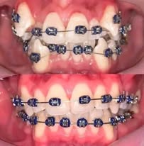 Orthodontie - Cas 2